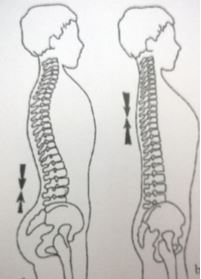 Os 5 lados da escoliose. Lado 1. Dimensao antero posterior.
