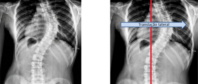 Os 5 lados da escoliose. Lado 5. Traslação lateral na escoliose.