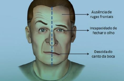 Exemplo de rosto de paciente com AVC